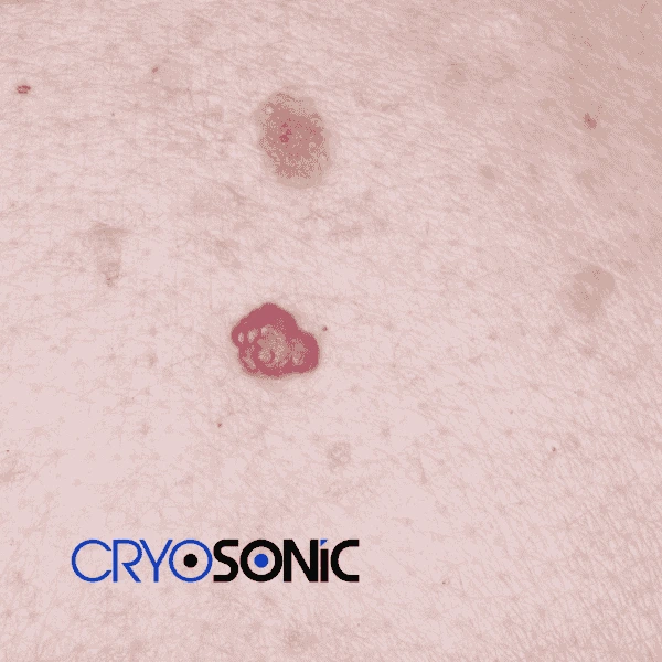 Looking for pain free cherry angioma removal treatment Sutton-Coldfield? Call our team today! Sutton-Coldfield