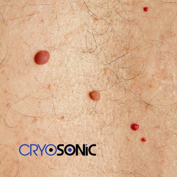 get cherry angioma removal treatment today! Sutton-Coldfield
