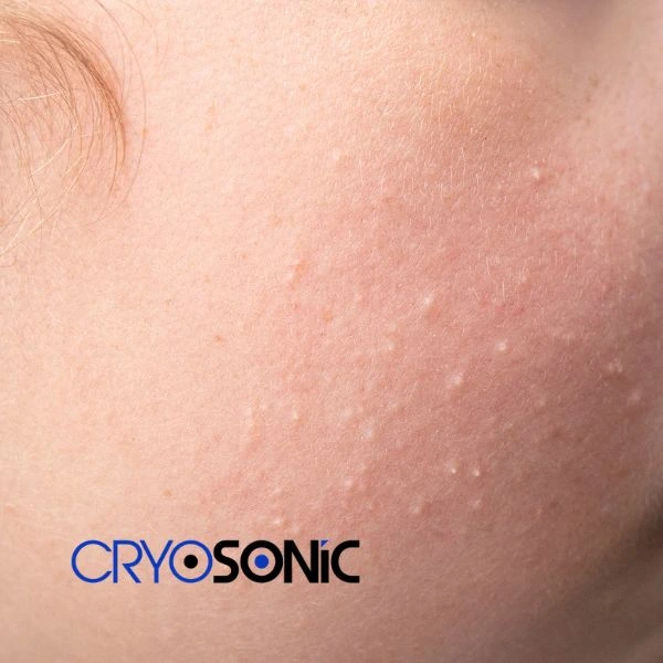 Are you looking for milia removal treatment? Contact our team today Sutton-Coldfield