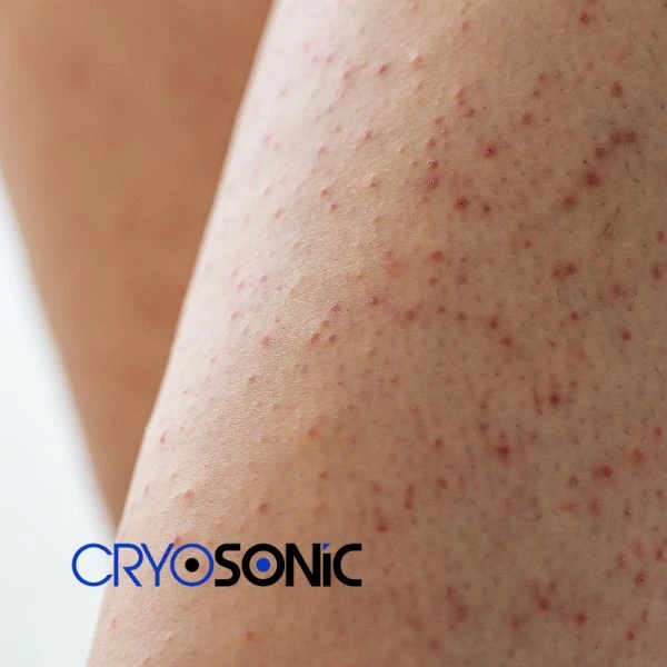 Looking for Seborrhoeic Keratosis removal Sutton-Coldfield treatment? Call our consultants today in Sutton-Coldfield