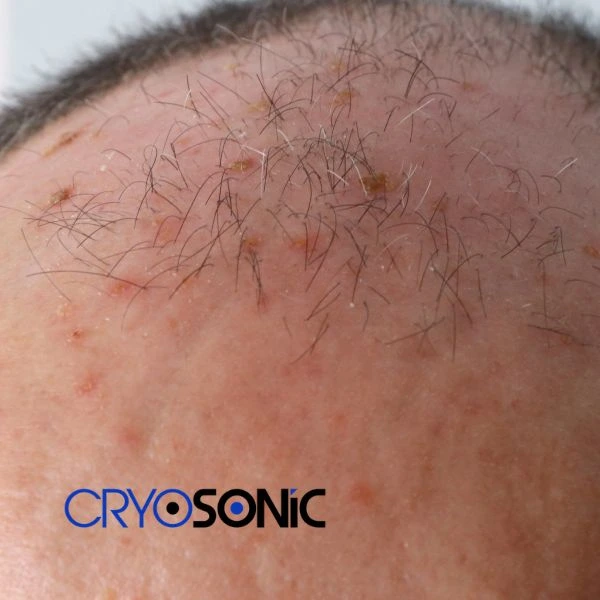 Access Seborrhoeic Keratosis removal from the comfort of your own home! Call us today in Sutton-Coldfield