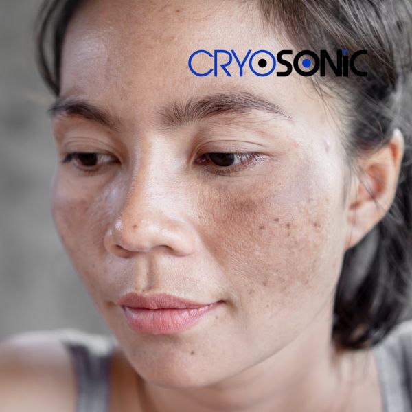 Ready to start age spots removal? Contact our team today in Sutton-Coldfield