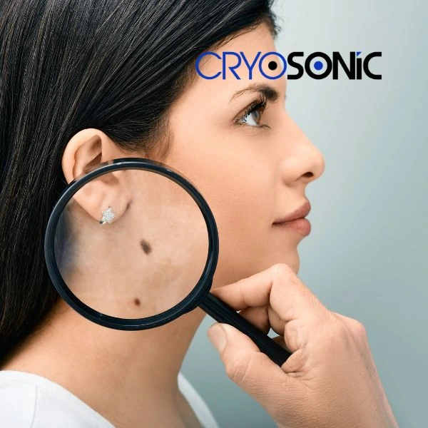 Do you want to learn more about benign moles removal treatment? Call our team today Sutton-Coldfield