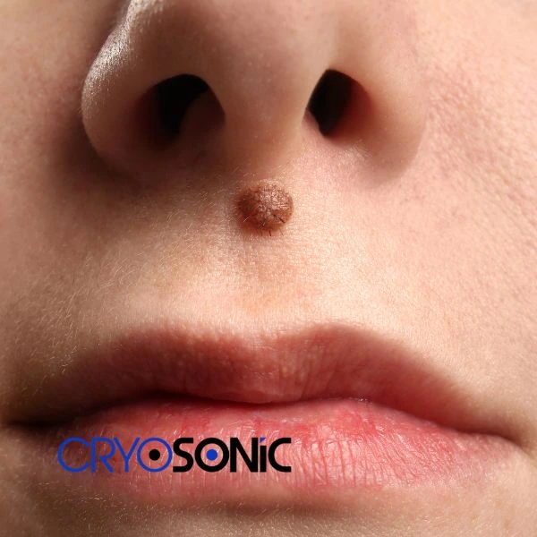 Start your benign moles removal treatment today Sutton-Coldfield