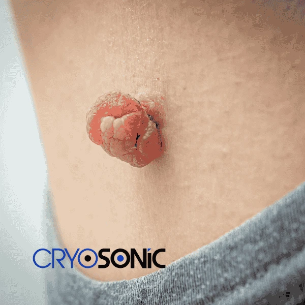 Book your skin tags removal Sutton-Coldfield from comfort of your own home! Sutton-Coldfield