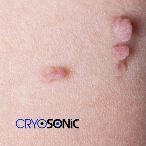 Are you looking for fast effect skin tag removal Sutton-Coldfield? Book in NOW! Sutton-Coldfield