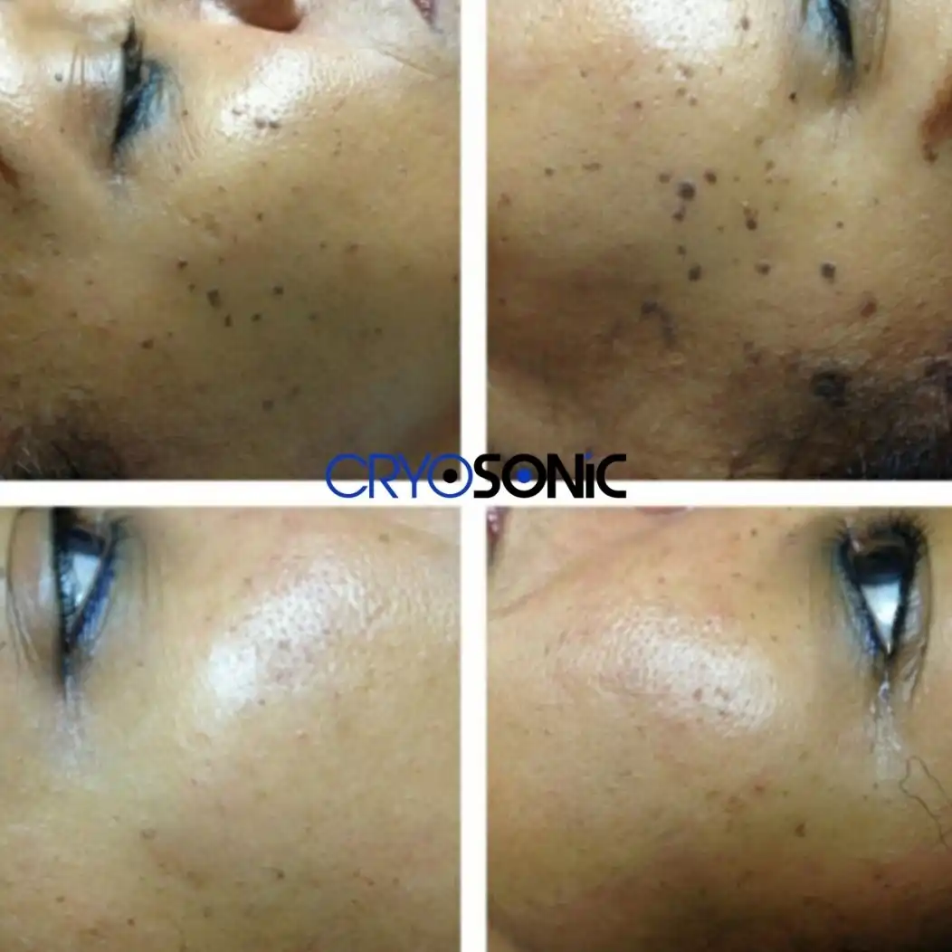 Why Skin Shows Pigmentation After Treatment Sutton-Coldfield
