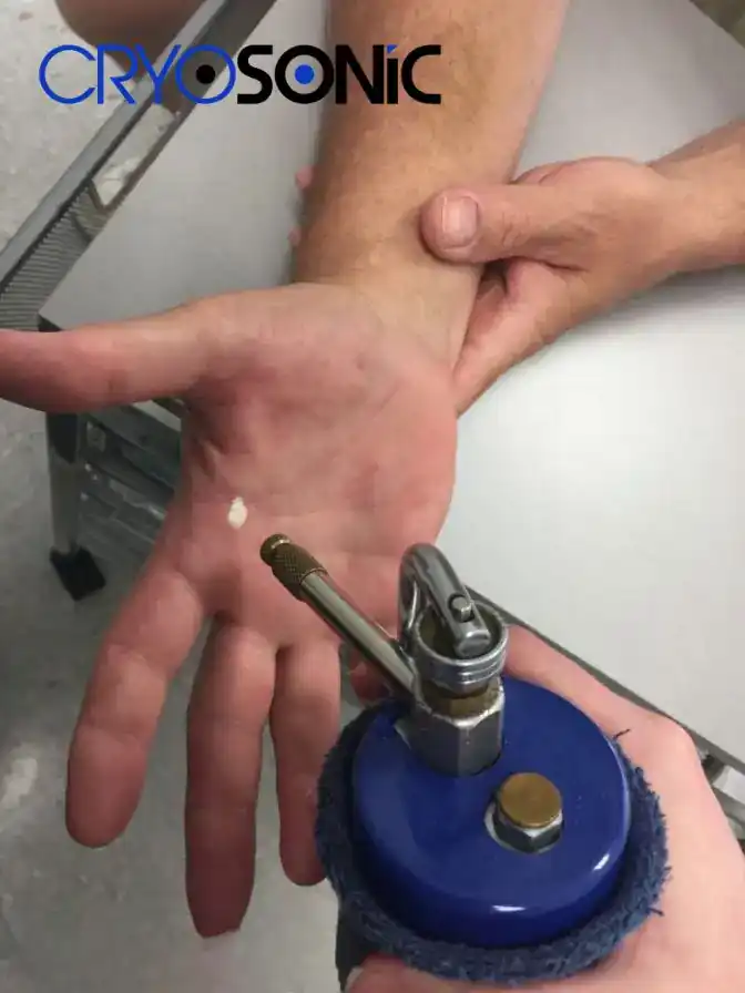 Temperature Differences: OTC vs Medical-Grade Cryotherapy Sutton-Coldfield